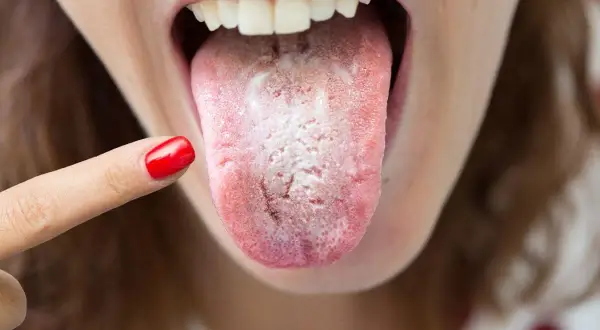 Dedo con uña roja señala una lengua con una llaga blanca, indicando posible candidiasis oral.