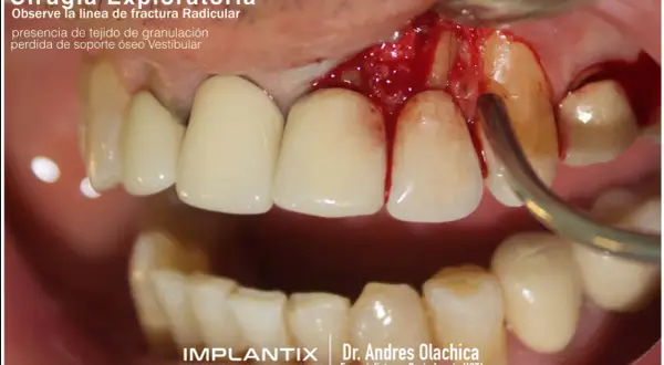 Exploración dental muestra una fractura radicular con tejido de granulación y pérdida ósea vestibular.