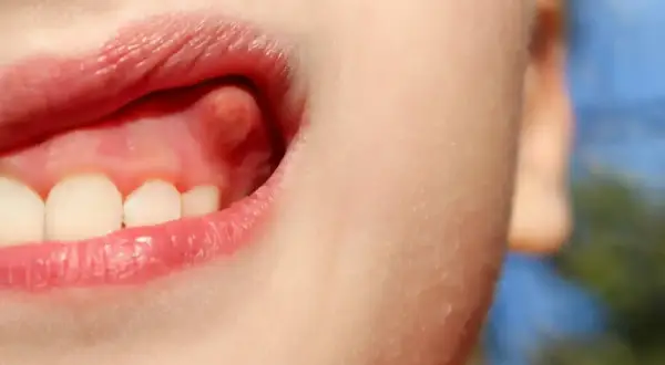 Bulto rojo en la encía, posible infección.