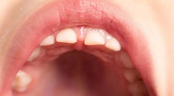 Boca de niño con dientes frontales que muestran signos de hipocalcificación del esmalte, con un aspecto opaco y ligeramente amarillento.