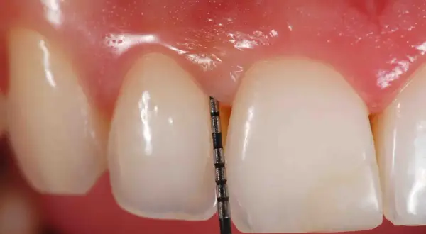 Una sonda dental mide el surco gingival. La gingivitis es contagiosa al besar, así que cuida tu salud bucal.