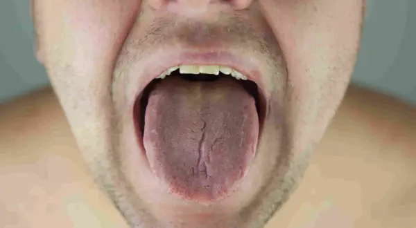 Primer plano de una boca abierta mostrando una lengua con placas y grietas.