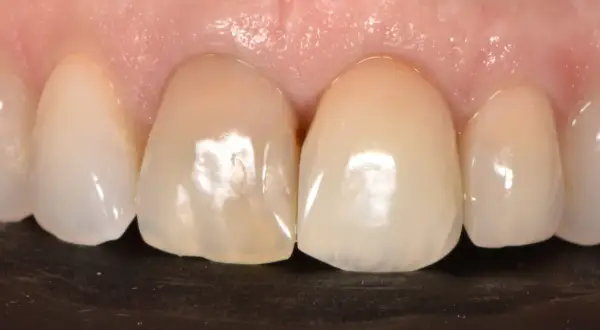 Primer plano de dientes frontales, uno de ellos muestra un diente delantero picado con una pequeña cavidad visible.