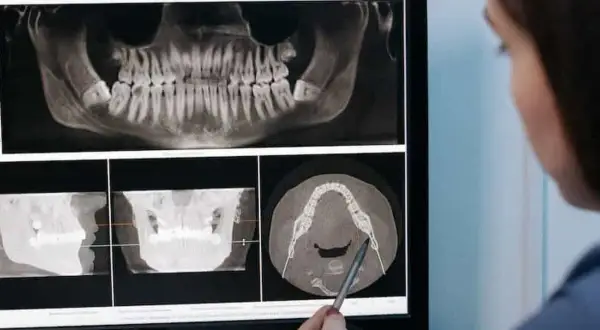 Dentista revisa radiografías dentales, incluyendo una vista panorámica y cortes transversales, para evaluar la necesidad de una elevación de seno maxilar que duele.