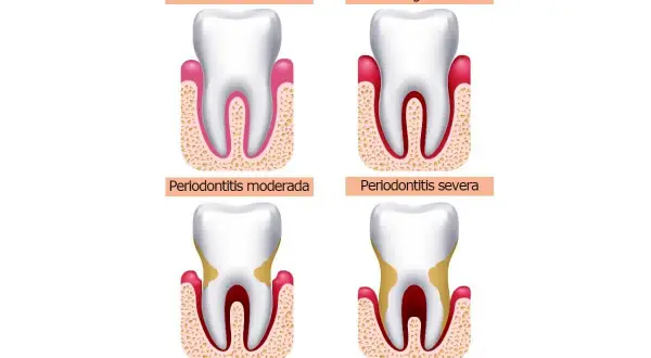 Ilustración muestra la progresión de la enfermedad periodontal, desde encía sana hasta periodontitis severa, con posible pérdida de dientes.
