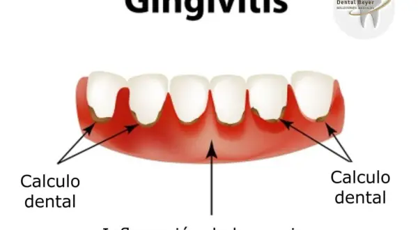 Ilustración de gingivitis con cálculo dental y encias muy inflamadas.