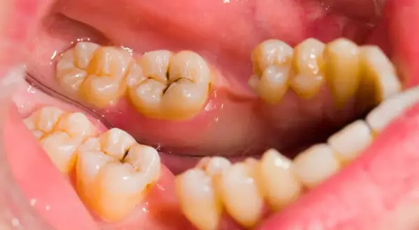Vista de cerca de dientes con manchas marrones por dentro, mostrando caries y empastes.