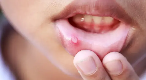 Una llaga en el labio, que puede ser contagiosa, se muestra de cerca.