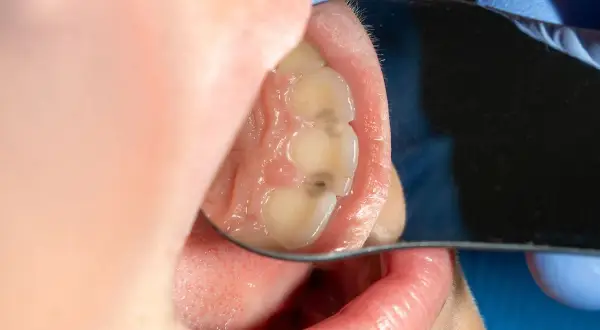 Vista de caras interproximales de los dientes, con caries visibles en algunas zonas.