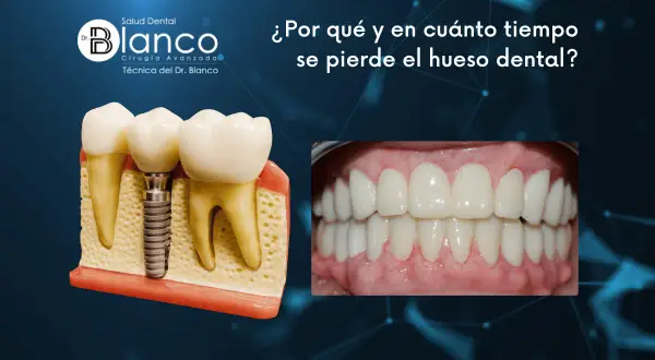 Modelo dental muestra implante y dientes. Foto de sonrisa perfecta. Información sobre cómo recuperar hueso encias.