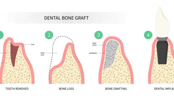 Ilustración del proceso de injerto óseo dental: extracción, pérdida ósea, injerto y colocación de implante para recuperar hueso dental.
