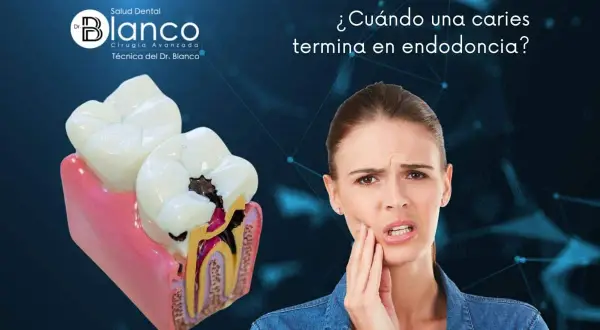 Una mujer con dolor de muelas mira un modelo dental que muestra una caries profunda. ¿Qué pasa si una caries llega al nervio?