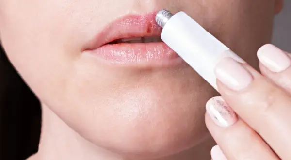 Aplicando crema para el herpes labial en un labio con una lesión.