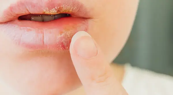 Labios con herpes, señal de defensas bajas. Una persona se toca el labio afectado.