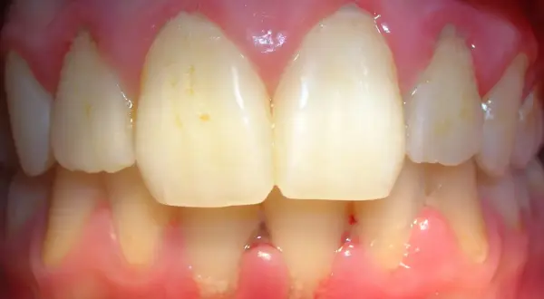 Encías inflamadas y enrojecidas, con signos de gingivitis por estrés. Se observan dientes con manchas y la línea de la encía retraída en algunas zonas.