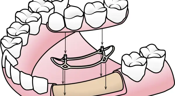 Si no tienes hueso para implante dental, una prótesis parcial removible como esta puede ser tu solución.