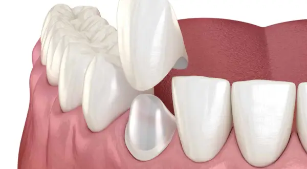 Coronas de disilicato de litio listas para ser colocadas en los dientes, mejorando la estética dental.