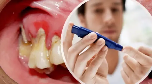 Dientes con caries y encías inflamadas, junto a un hombre midiéndose el azúcar. La diabetes puede empeorar la salud bucal.