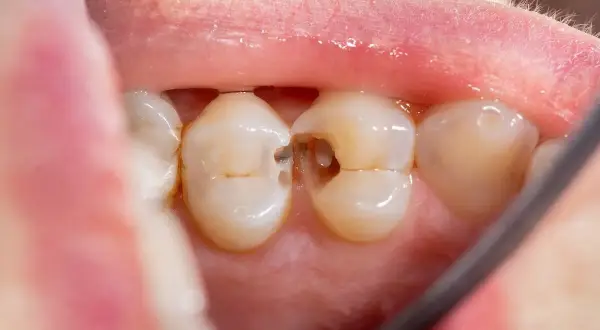 Vista de cerca de una muela con una caries visible. Se aprecian los dientes sanos y la cavidad oscura de la caries.
