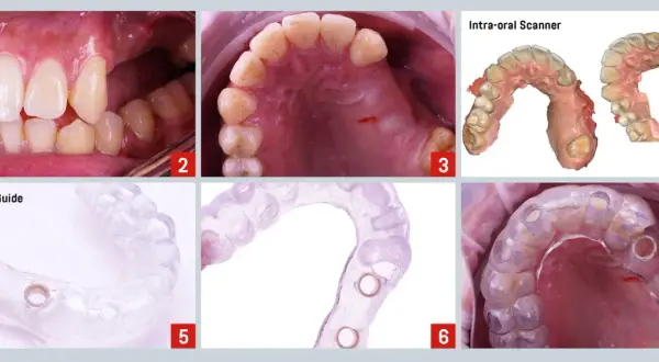 Guía quirúrgica para implantes dentales, planificando un puente dental en los dientes delanteros.