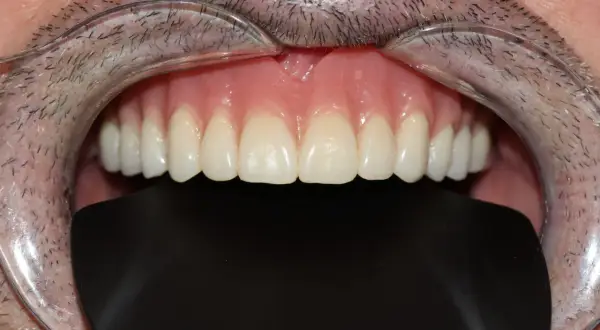 Una dentadura sin dientes, con encías rosadas y dientes postizos blancos y perfectos, se muestra en primer plano.