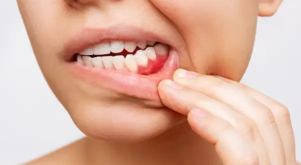 Encía inflamada y enrojecida, con signos de sangrado, quizás por el uso incorrecto del hilo dental.