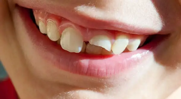 Sonrisa de niño con un diente partido por la mitad, mostrando que se puede arreglar.