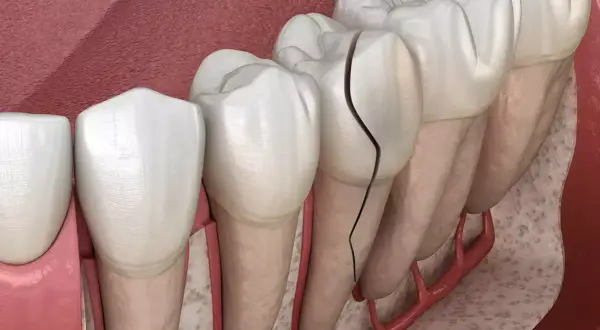 Dientes delanteros con grietas visibles, mostrando el daño en el esmalte y la pulpa.