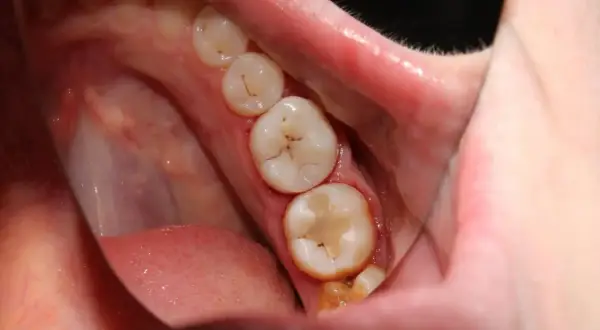 Boca con molares empastados, mostrando la importancia de la prevención de caries para mantener una sonrisa sana.
