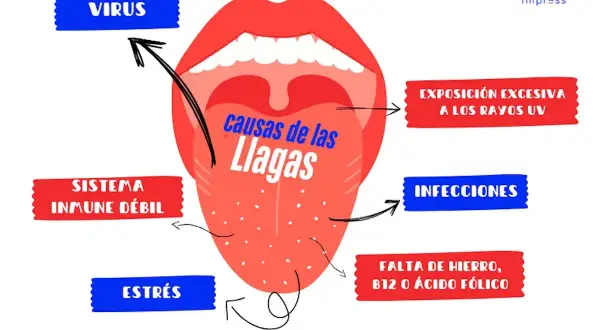 Ilustración de boca abierta mostrando la lengua con puntos, con flechas que señalan las ampollas en la boca causas: virus, sistema inmune débil, estrés, exposición UV, infecciones, falta de hierro/B12/ácido fólico.