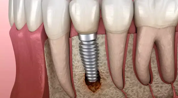 Ilustración de un implante dental con bolsas inflamatorias alrededor, mostrando la pérdida ósea y la irritación de los tejidos.