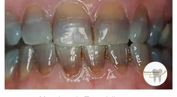 Dientes con manchas verdes y amarillas, indicativo de manchas de tetraciclina.
