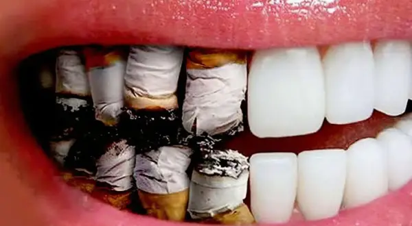 Dientes amarillentos y dañados por el efecto negativo del tabaco en nuestros dientes.