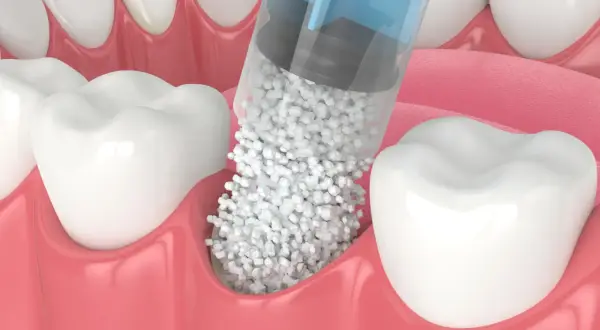 Jeringa aplicando material para poner hueso en la encía, cerca de los dientes.