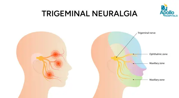Ilustración muestra el nervio de la boca y sus zonas de afectación en la neuralgia trigeminal, con puntos de dolor en la cara.