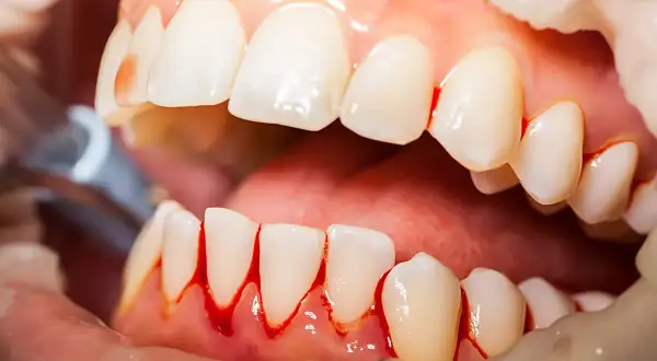 Encías sangrantes alrededor de los dientes, una posible causa de porque sangran las encias de noche.