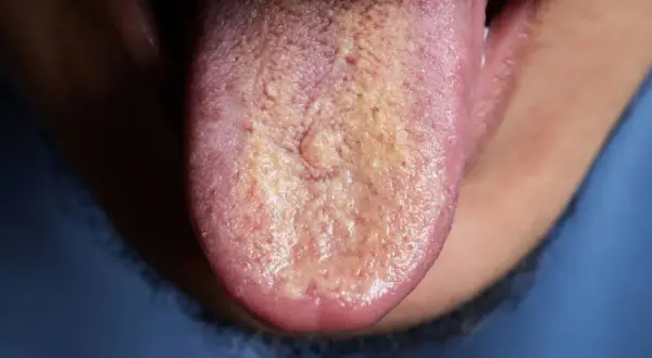 Lengua con capa blanquecina y amarillenta. ¿Cómo saber si me huele el aliento? Podría ser una señal.