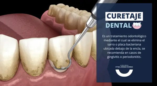 Instrumento dental elimina sarro bajo la encía. El curetaje dental es esencial para tratar la gingivitis y periodontitis.