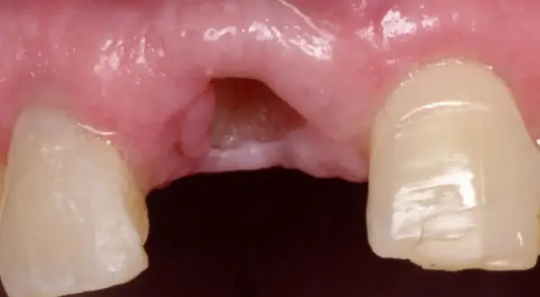 Gingiva con espacio desdentado y dientes adyacentes. Se observa la necesidad de limar diente astillado para mejorar la estética y función.
