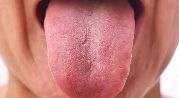 Lengua rosada con una capa blanquecina, posiblemente por uso de clorhexidina.