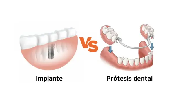 Comparación de implante dental y prótesis para solucionar la falta de dientes.