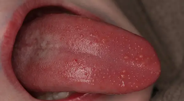 Lengua rosada con múltiples ampollas pequeñas y blancas, algunas rojas, visibles en la superficie.