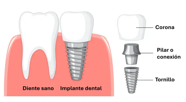 Ilustración de un diente sano y un implante dental con sus componentes: corona, pilar y tornillo dental.