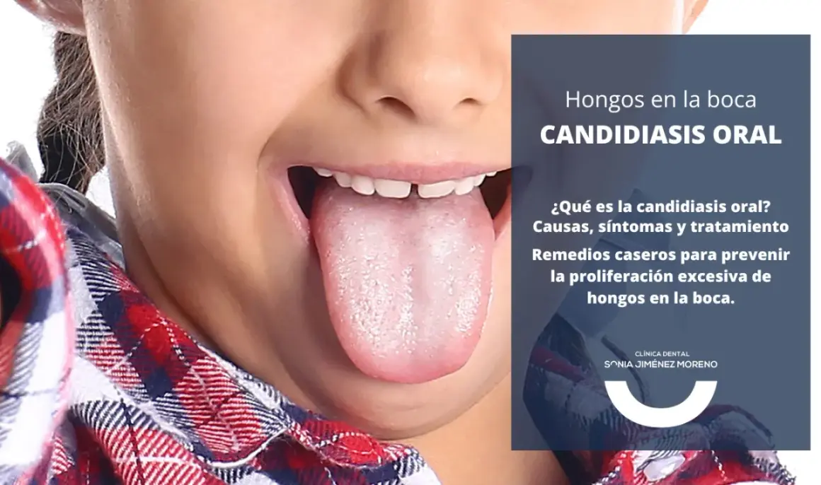 Primer plano de una lengua con aspecto blanquecino, indicando candidiasis oral. El texto informa sobre causas, síntomas y tratamiento.