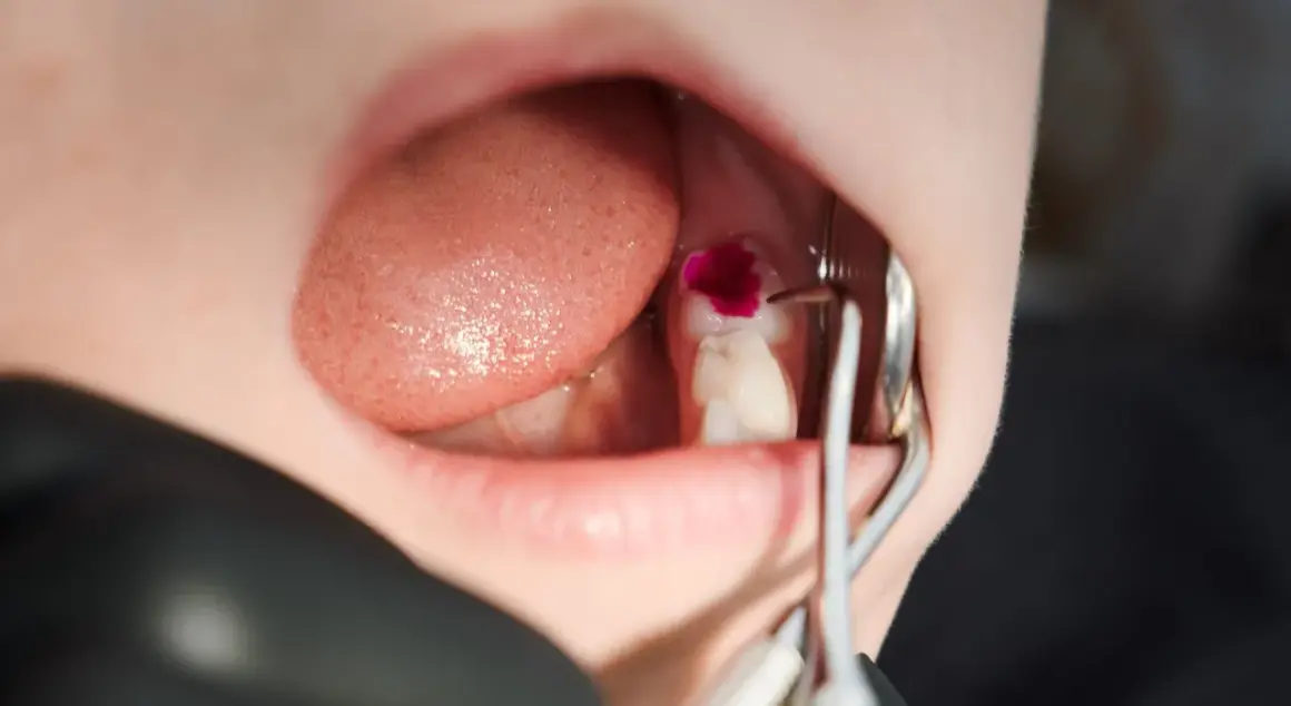 Detalles de cómo se limpia una caries con un tinte revelador y herramientas dentales.