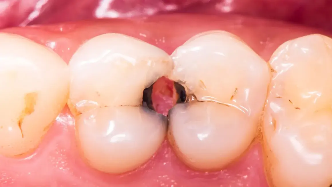 Caries severa en la arcada dental inferior, con cavidades profundas entre los dientes.