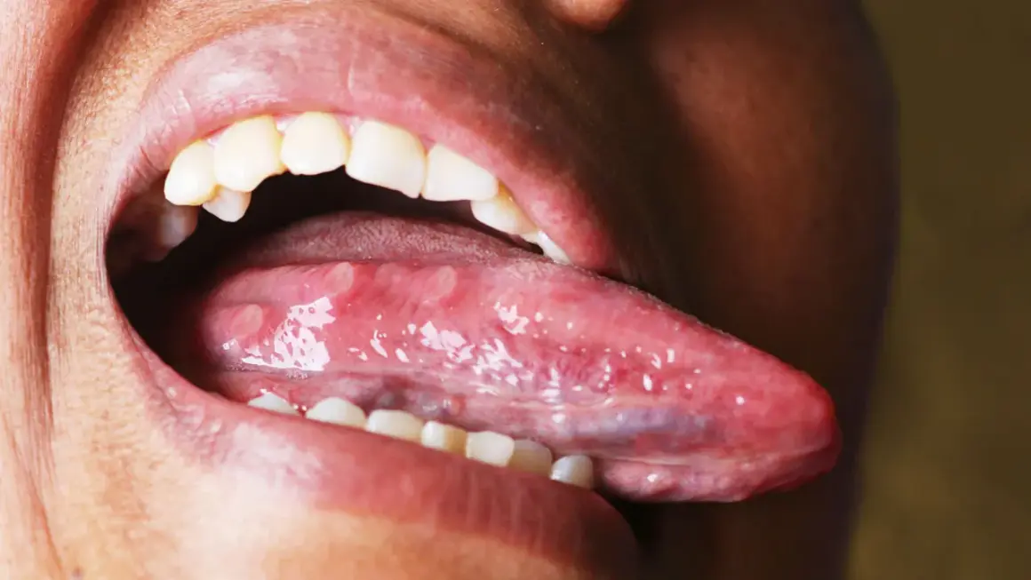 Boca abierta mostrando la lengua con múltiples llagas blancas y rojas, una llaga en la lengua que no se cura.