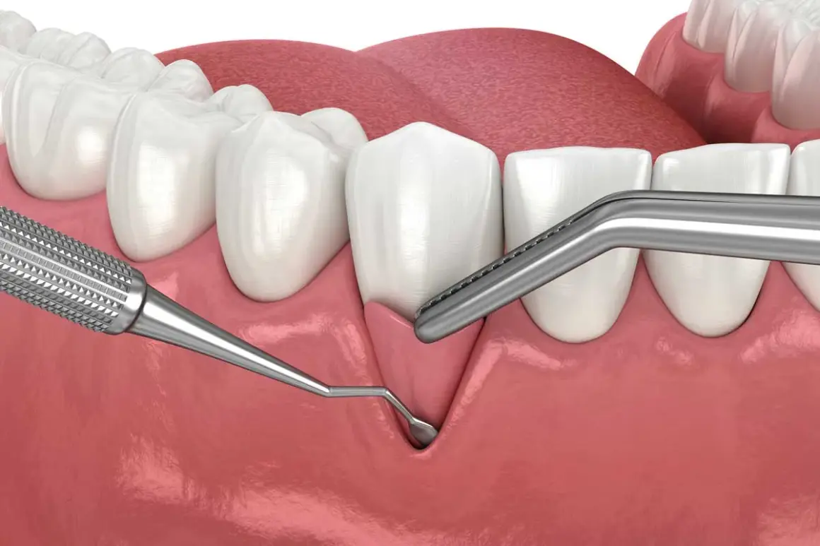 Ilustración dental que muestra el inicio de un trasplante de encía, con instrumentos quirúrgicos listos para el procedimiento.