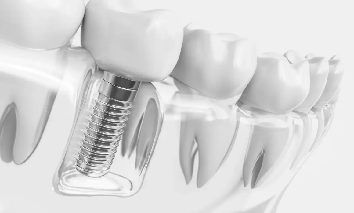 Detalle de implantes dentales tornillos, mostrando su integración en el hueso y la corona dental.