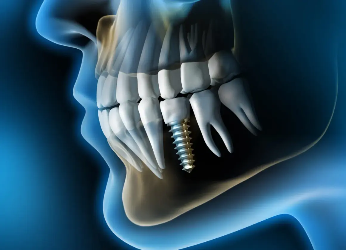 Implante dental en el hueso maxilofacial, mostrando la estructura ósea y los dientes.